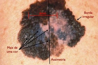Carcinoma basocelular