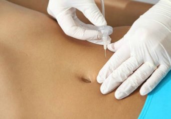 Carboxiterapia